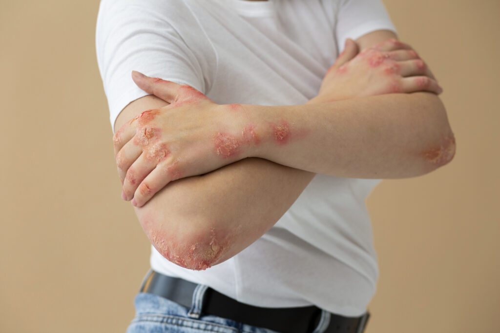 Psoriasis en el cuerpo