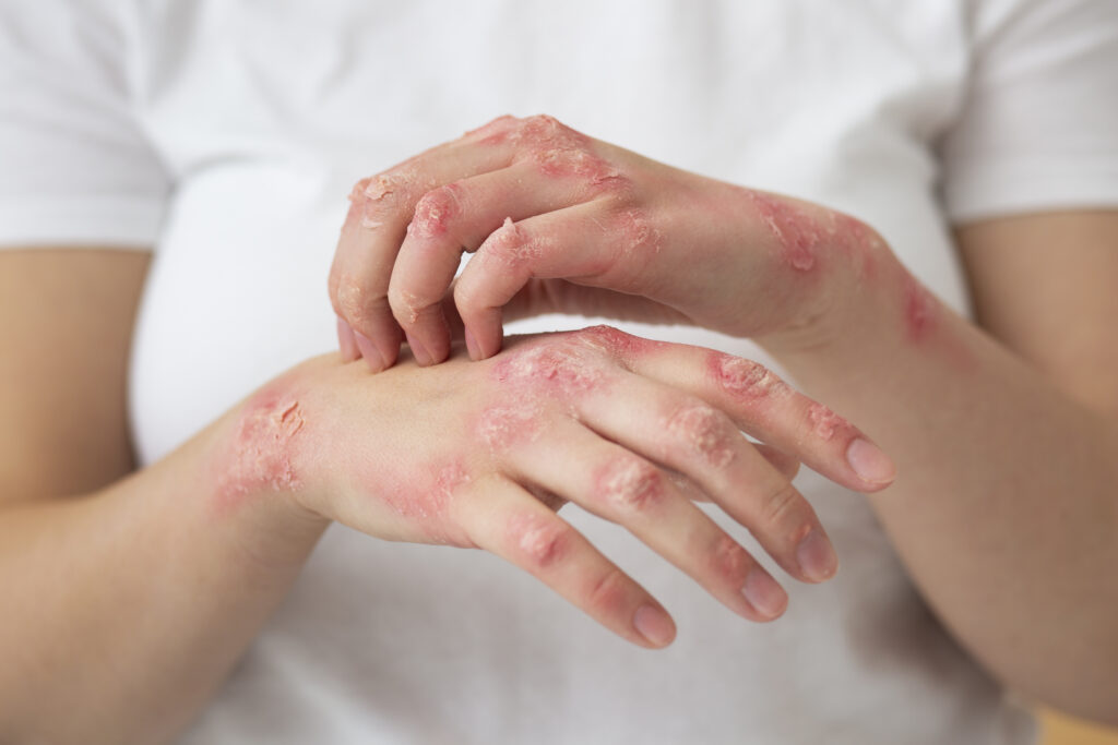 Psoriasis en manos