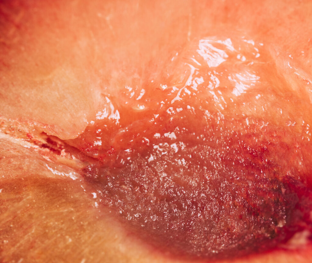 otra de nuestro tratamiento de verrugas