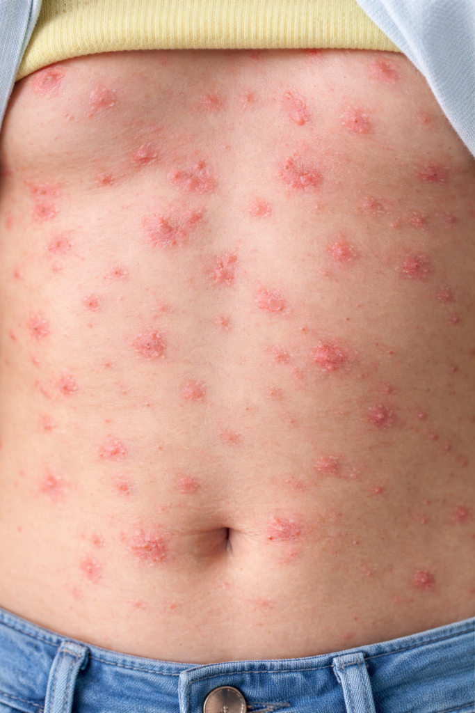 otra imagen de psoriasis guttata rara